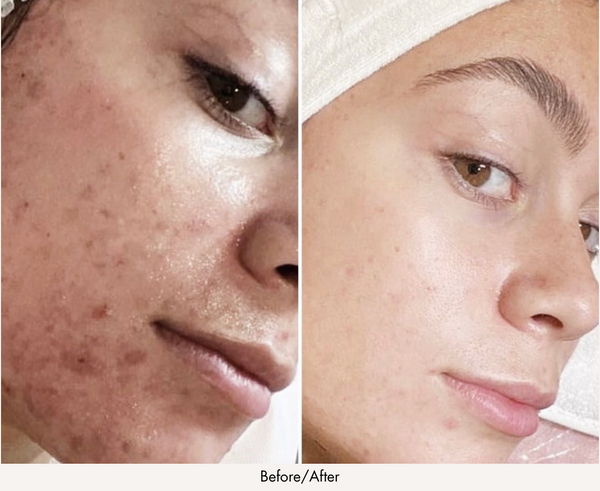 Winter is the Best Time To Have a Chemical Peel | Here's why